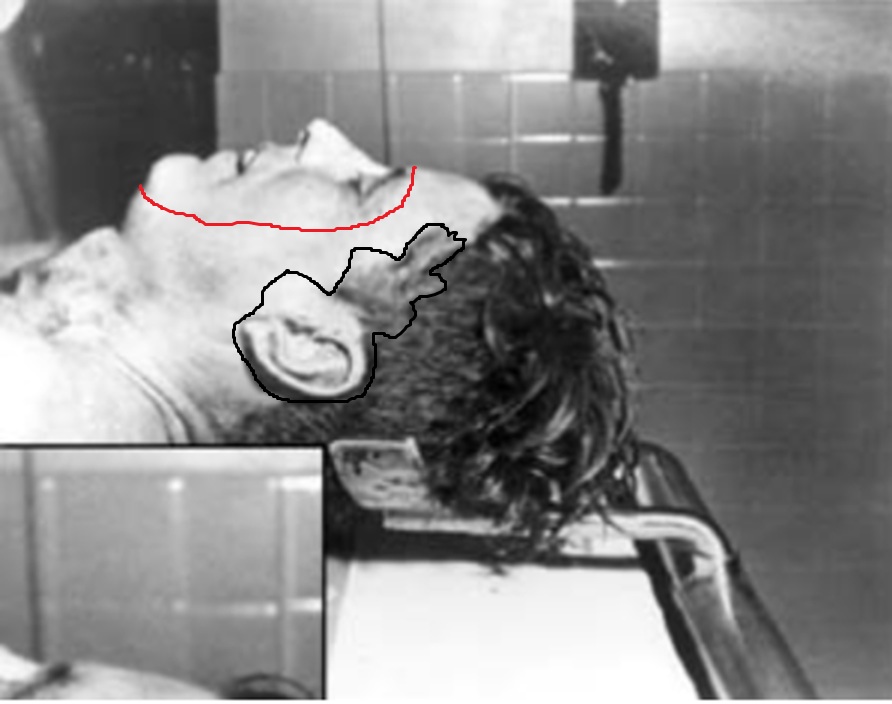 JFK autopsy photos – the final mile – Piece of Mindful
